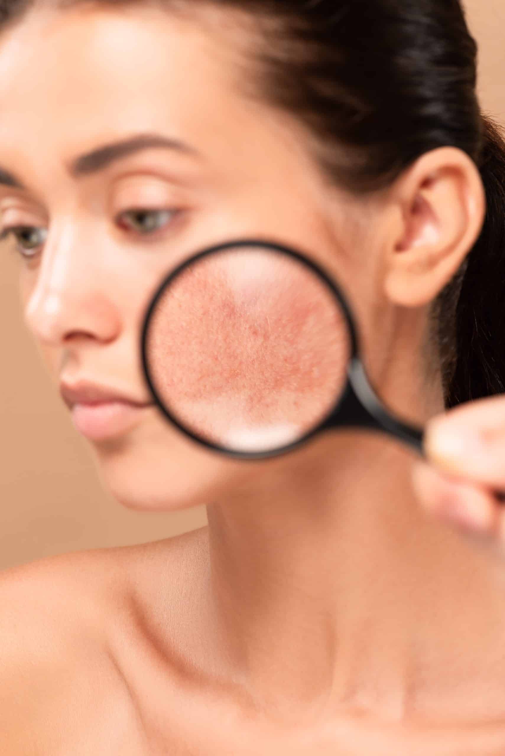 Skincare for Rosacea: How to Keep Your Skin Happy and Calm